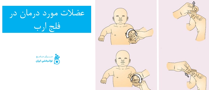 عضلات مورد درمان در فلج ارب