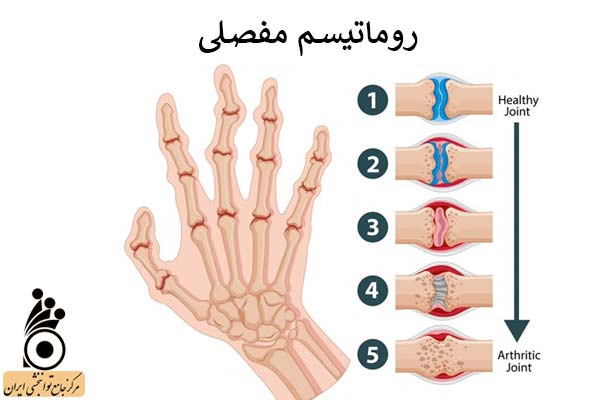 روماتیسم مفصلی روماتیسم مفصلی
