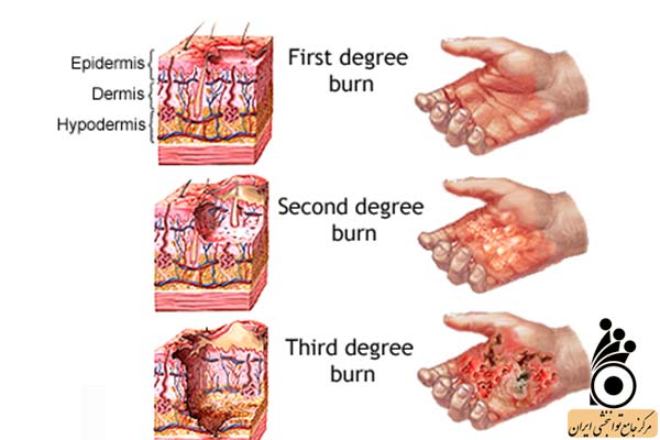 درجات مختلف سوختگی درجات مختلف سوختگی