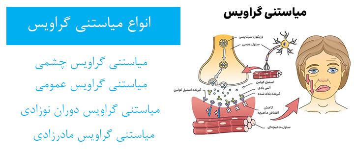 انواع میاستنی گراویس