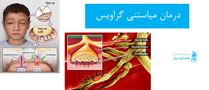 درمان میاستنی گراویس