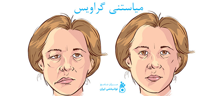 میاستنی گراویس چیست؟