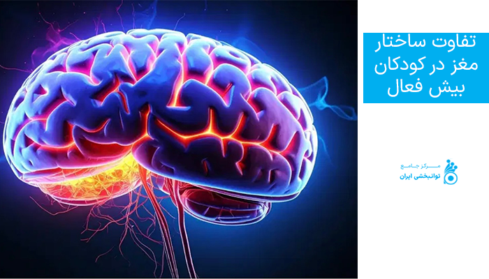 تفاوت ساختار مغز در کودکان بیش فعال